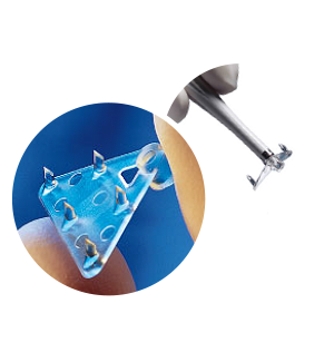 Phẫu Thuật Treo Chân Mày Nội Soi Endotine-Biobsorb Fixtine